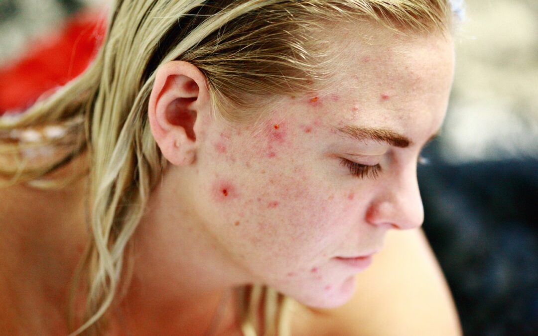 Types of Acne and What to Know About Them